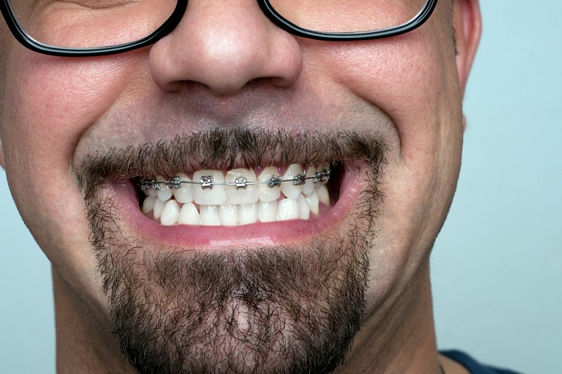 mężczyzna w aparacie ortodontycznym